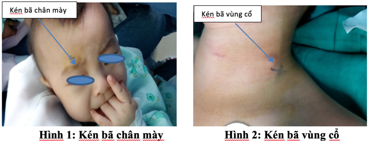 Kén bã | Phẫu thuật nhi